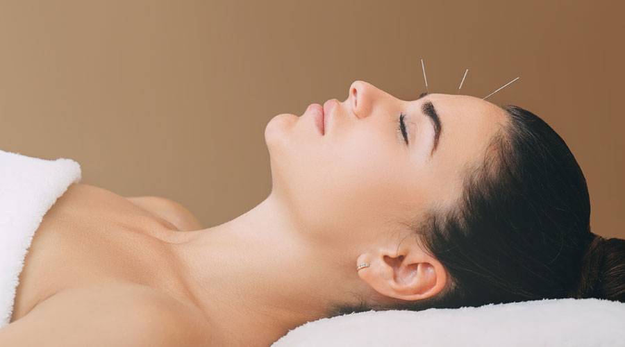 migraine et acupuncture